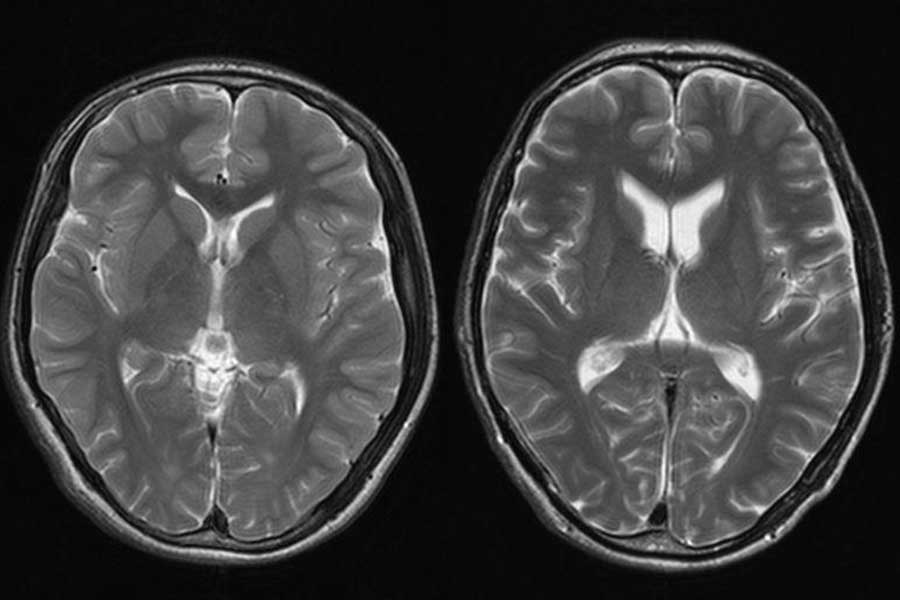 10代（左）と60代の脳のMRI画像の比較【写真提供：スポーツ安全指導推進機構】